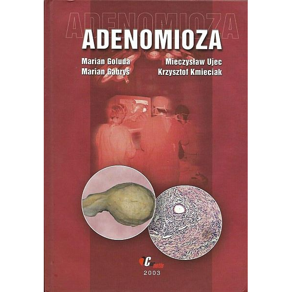 Adenomioza