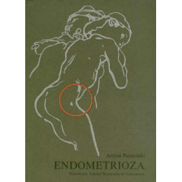 Endometrioza